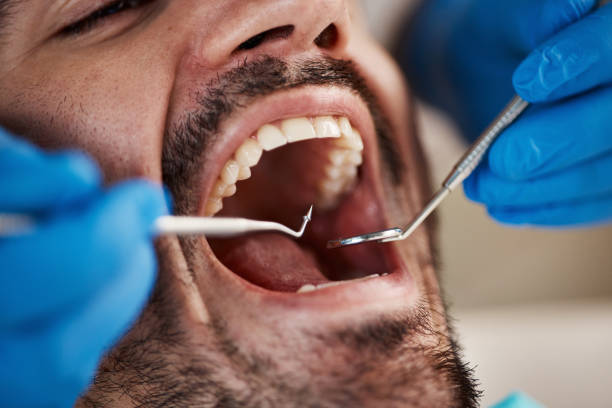 Dental Inlays and Onlays in Monroe, WA
